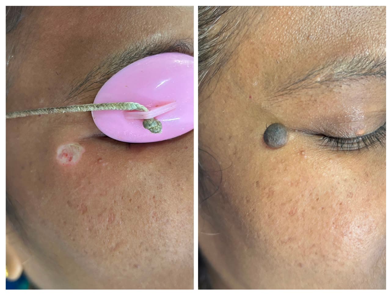 Eyelid & Periorbital Benign Lesion Excision