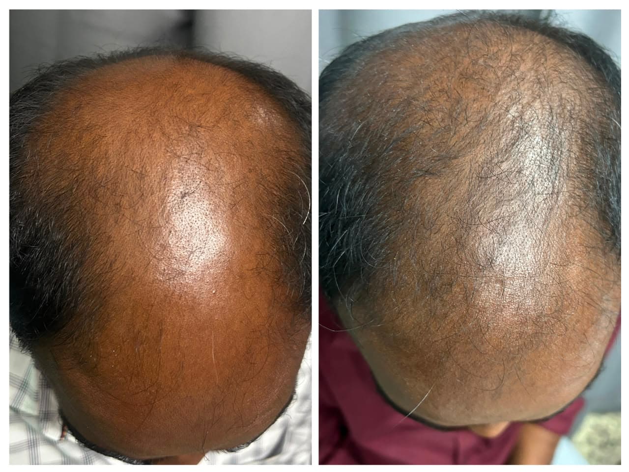 Androgenetic Alopecia (Vertex & Crown)