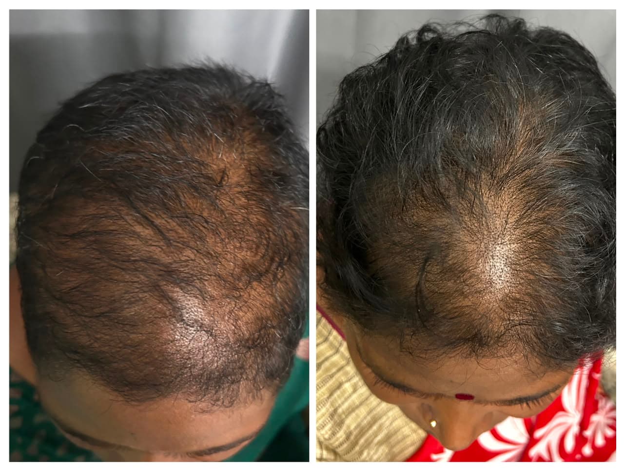 Female Pattern Hair Thinning