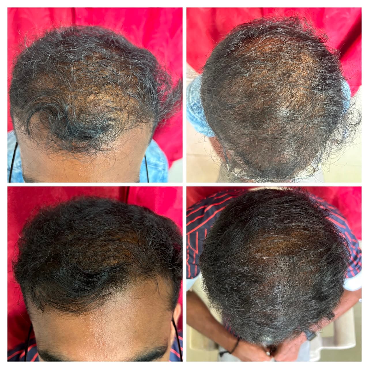 Frontal Hairline & Mid-Scalp Density